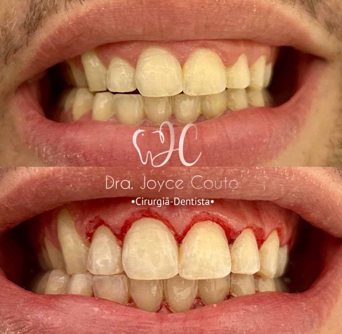 Gengivoplastia, pós-imediato
